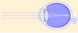 ojo miope
