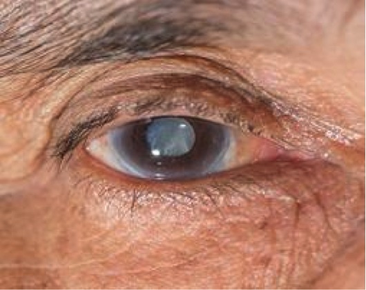 cataratas ojo